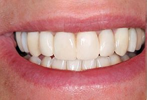 Mark G. Womack, DDS | Nerve Repositioning, Apicoectomies and Impacted Wisdom Teeth