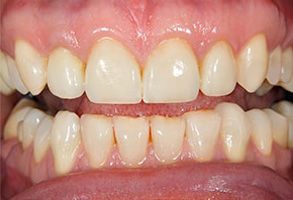 Mark G. Womack, DDS | Implant Supported Overdenture, Facial Trauma and Missing All Upper or Lower Teeth