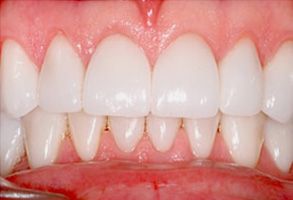 Mark G. Womack, DDS | Impacted Teeth, Implant Supported Overdenture and About Bone Grafting