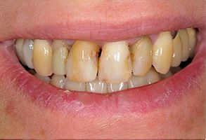 Mark G. Womack, DDS | Wisdom Teeth Removal, Ridge Augmentation and Jaw Bone Loss and Deterioration