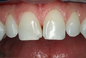 Mark G. Womack, DDS | Apicoectomies, Jaw Bone Health and Replacing Missing Teeth